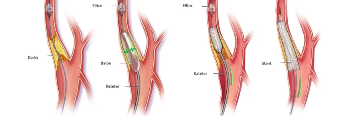 Karotid Stenozu: Tərif, Səbəbləri və Müalicə Yolları