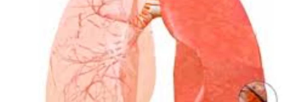 Ağciyər emboliyası