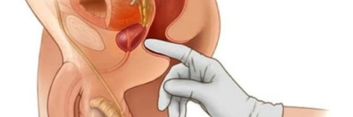 Prostat vəzinin adenoması