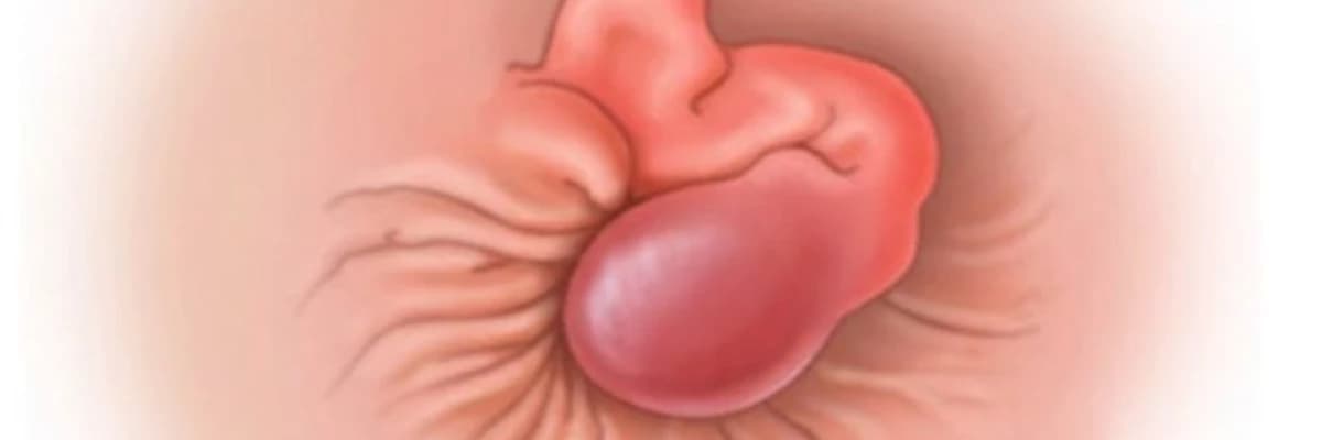 Kəskin hemorroidal tromboz (tromboz ilə fəsadlaşmış babasil)