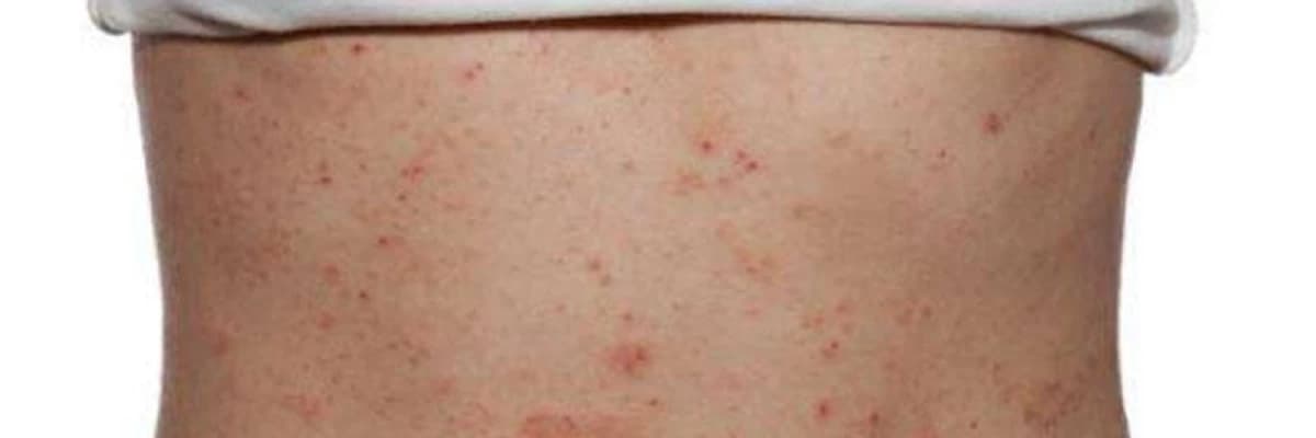 Uşaq dəri xəstəlikləri haqqında