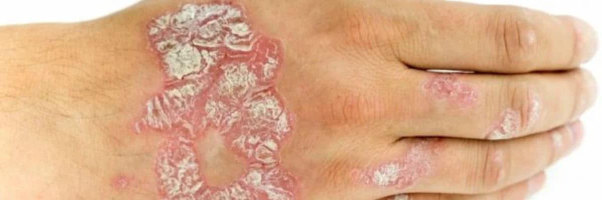 Psoriasis: Dərinin xroniki və iltihablı bir xəstəliyi
