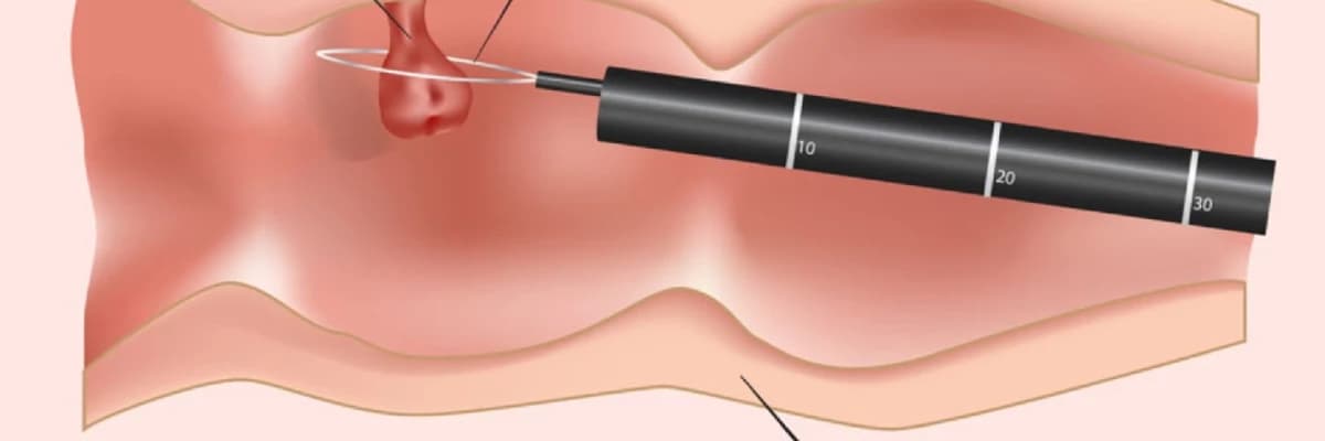 Poliplərin endoskopik cərrahiyyəsi