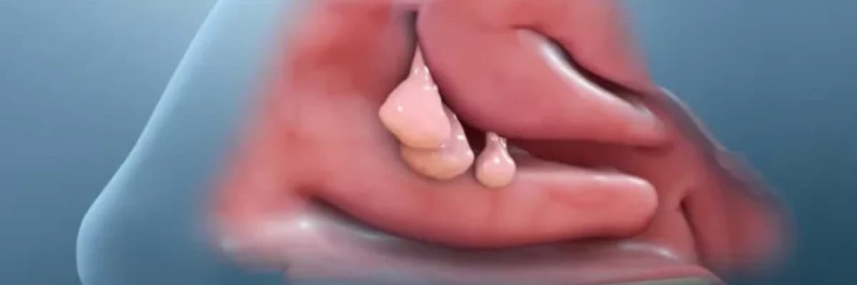 Konxa (Burun əti) xəstəliyi