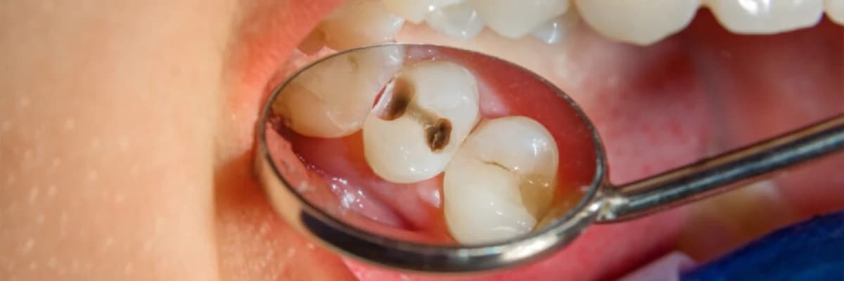 Diş Çürükləri (Dental Karies): Səbəbləri, Simptomları və Müalicə Yolları