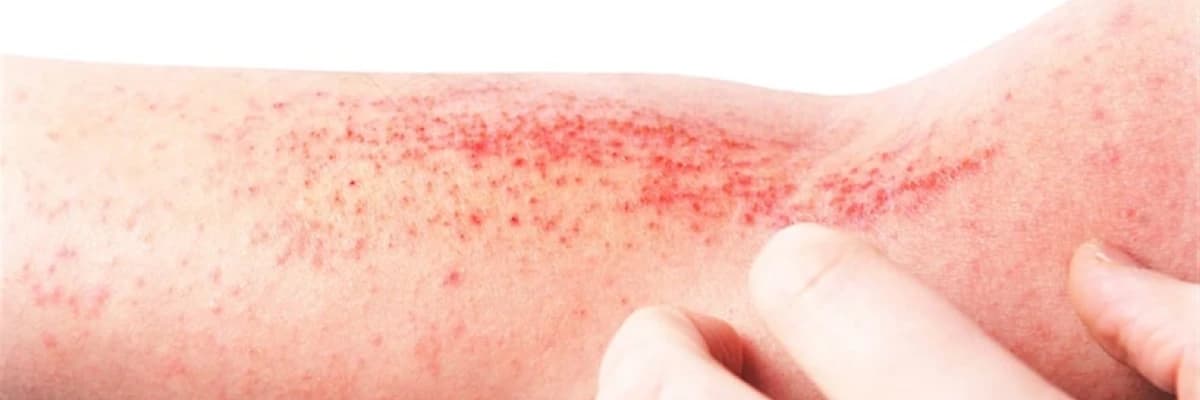 Dermatit: Dəri İltihabının Nəzərə Alınması