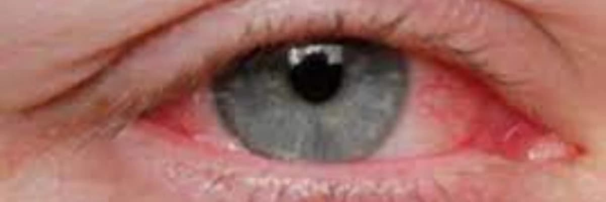 Gözdə yad cisim hissi