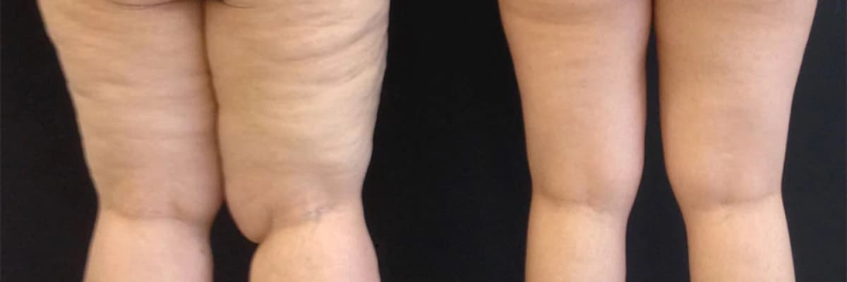 Lipödem (Lipedema) Tedavisi