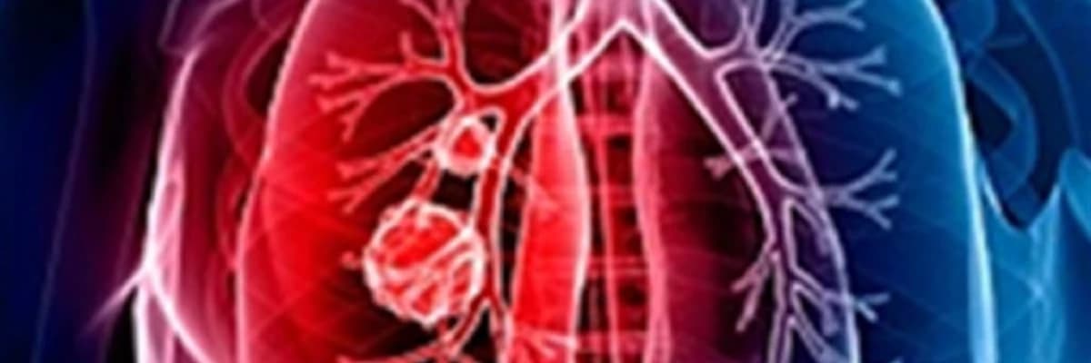 Ağciyər emboliyası