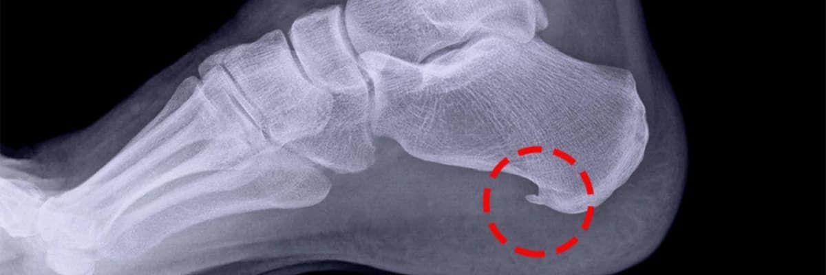 Daban tıxacları və müalicə üsulları