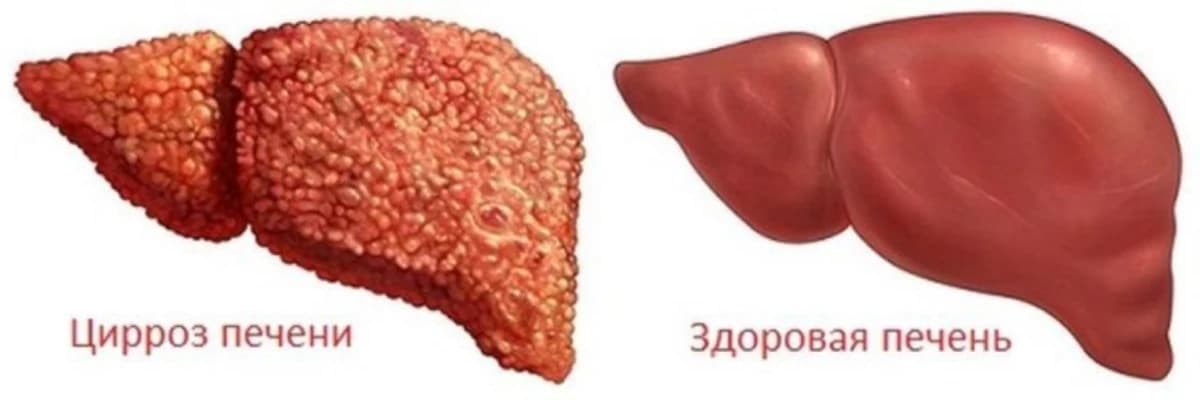 Qaraciyər xəstəlikləri (hepatit, siroz)