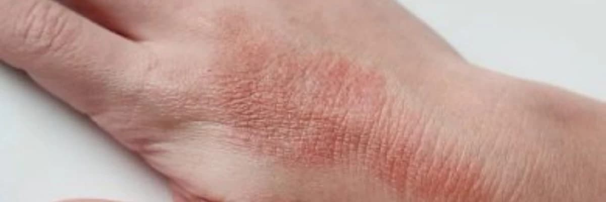 Pemfiqus xəstəliyi və ya Pemphigus Vulgaris