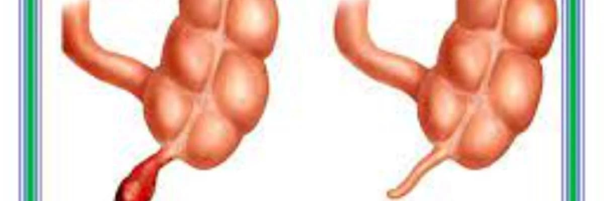 Appendisit