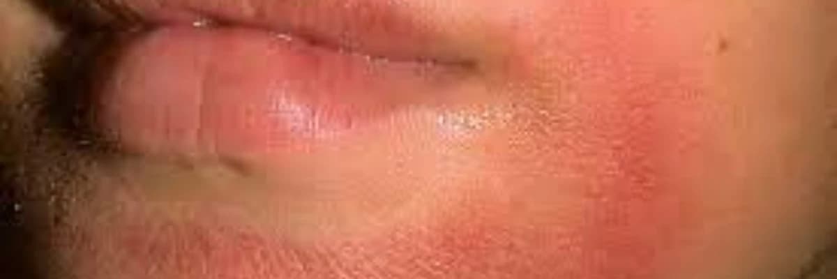 Səpgi, qaşınma ilə müşahidə olunan dəri xəstəliklərinin differensiasiyası, diaqnostika və müalicəsi