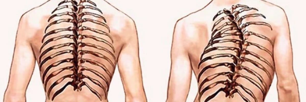 Onurğa sütununun iltihabi xəstəlikləri: simptomlar, diaqnoz və müalicə