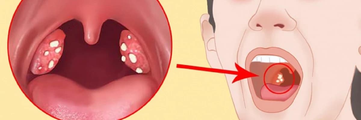 Kataral angina xəstəliyi