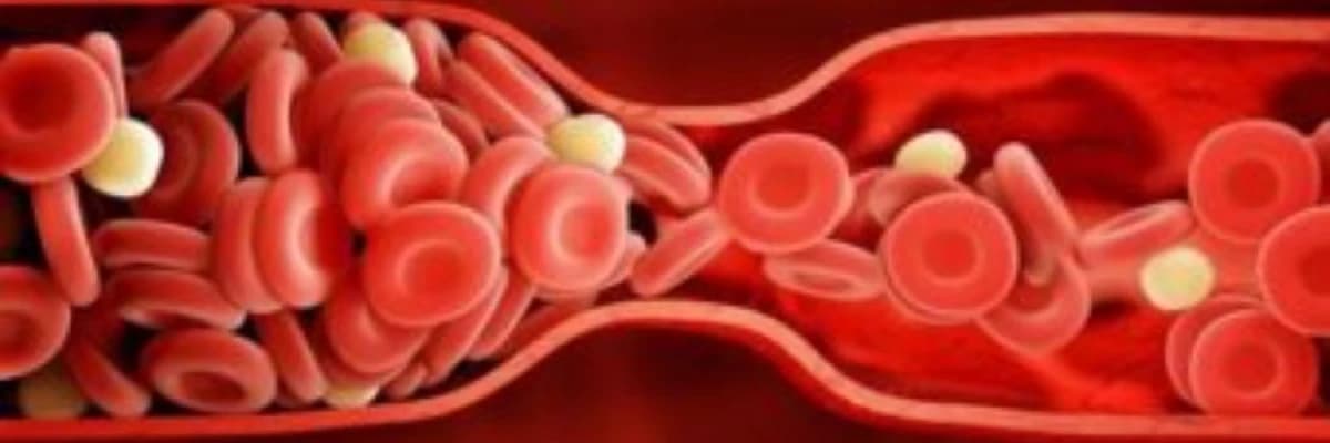 Yayılmış damardaxili laxtalanma