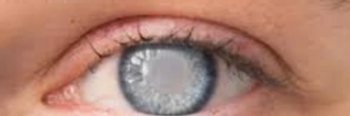 Katarakta (mirvari suyu)