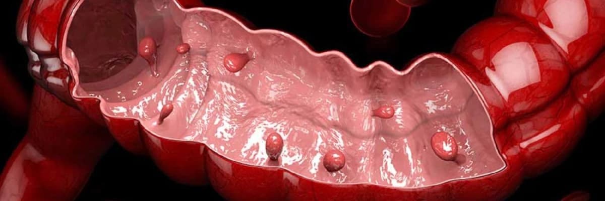 Anal polip xesteliyi