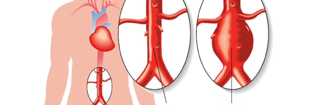 Aorta Anevrizması Cərrahiyyəsi: Həyat Xilasedici Prosedur
