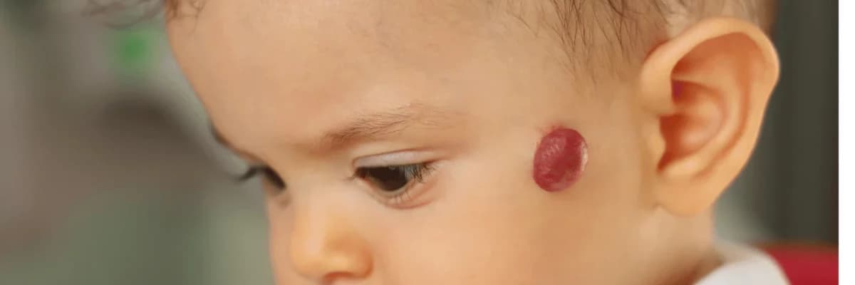 Yenidoğulmuşlarda Hemangiomaların Yüksək Risk Faktorları: Riskli Hallar və Diqqət Edilməli Məqamlar