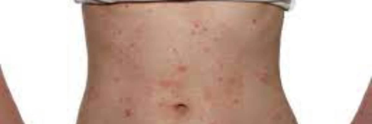 Allergik kontakt dermatit