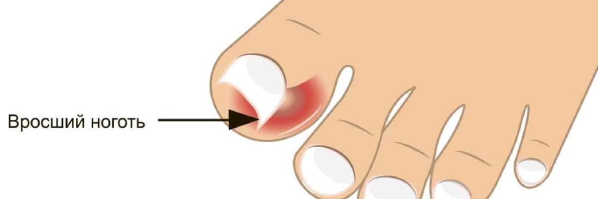 Batıq Dırnaq: Ağrılı Vəziyyətin Arxasındakı Qeyri-adi Ad