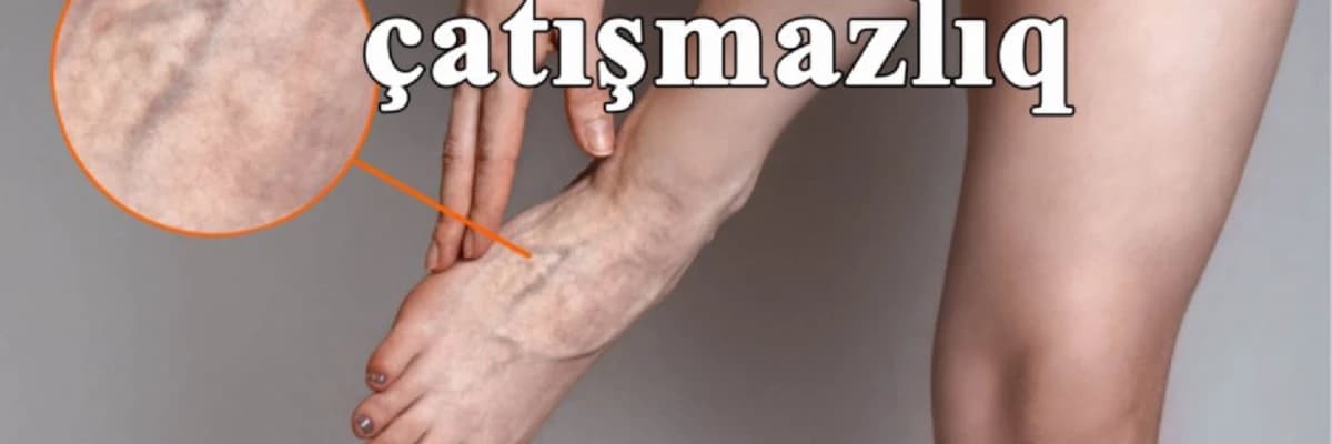 Xroniki venoz çatışmazlıq və ya varikoz damarları nədir?