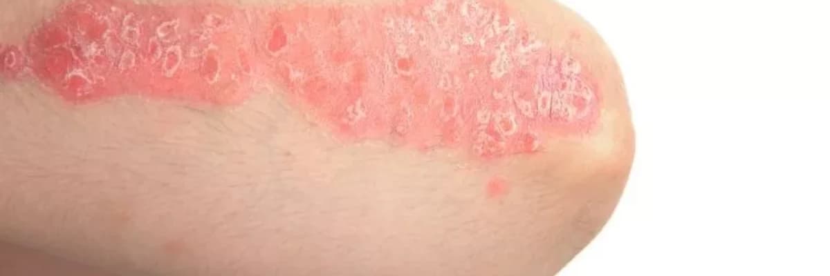 Psoriasis: simptomlar, səbəblər və müalicələr