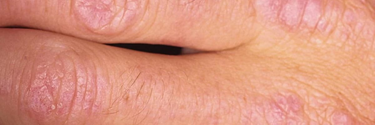 Dermatomiozit