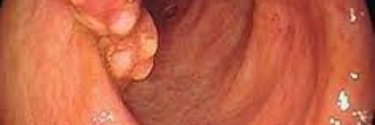 Çenber bagirsagin psevdopolipozu