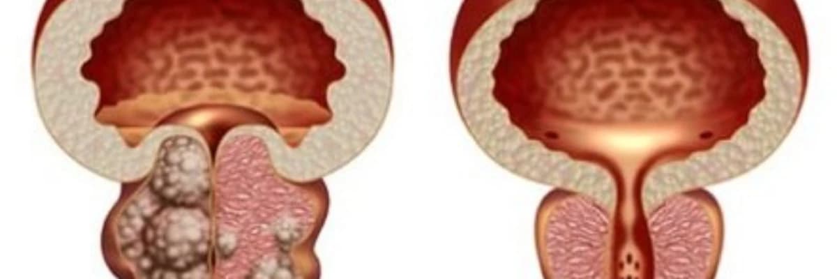 Prostat biopsiyası necə olmalıdır?