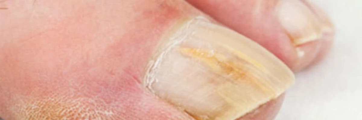 Onixomikoz (Dırnaq göbələyi)