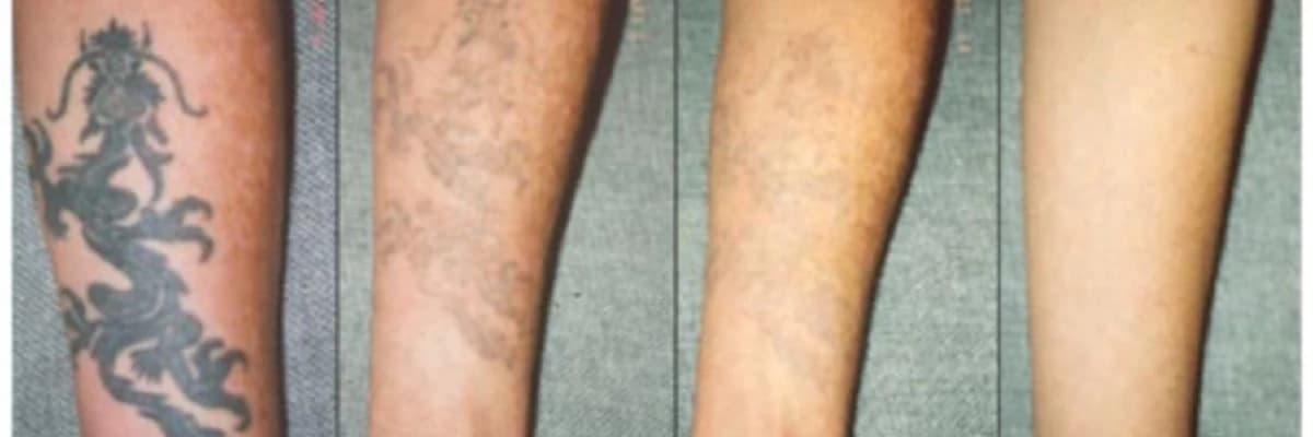 Tattoo Silmə - Tatuların Silinməsi