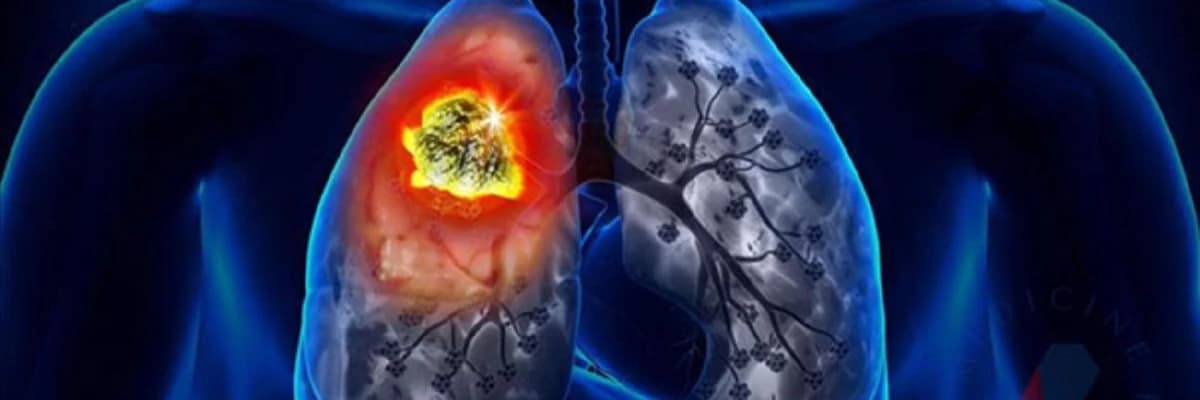 Ağciyər Xərçəngi: Səbəblər, Simptomlar və Müalicə Yolları