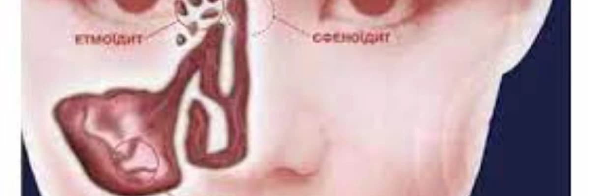 Kəskin rinit xesteliyi