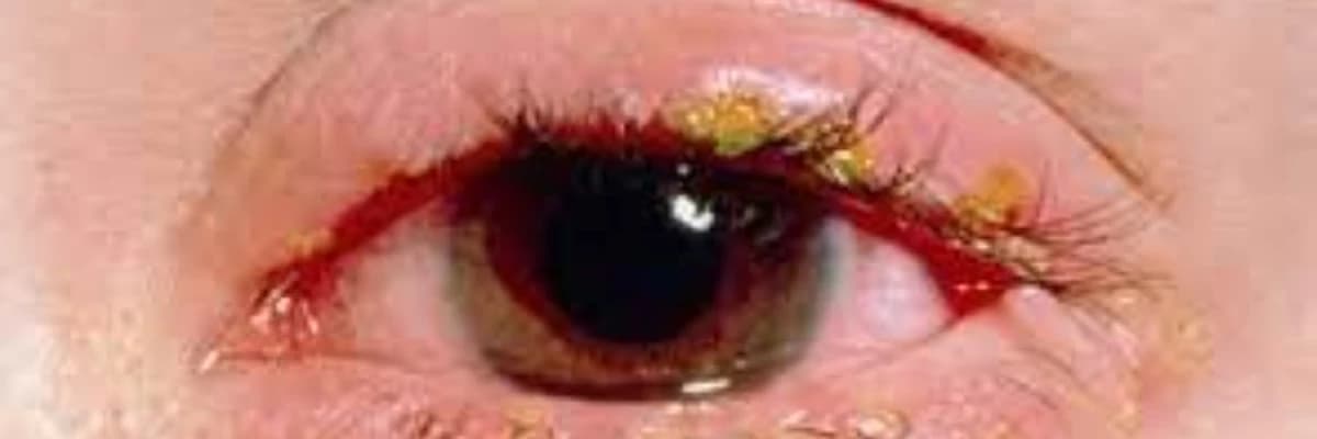 Göz infeksiyaları