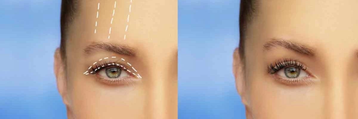 Göz qapaqlarının estetikası haqqında məlumat