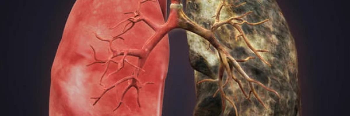 Ağciyər metaztazları cərrahiyəsi (böyrək, bağırsaq, beyin, qaraciyər xərçəngi və s)