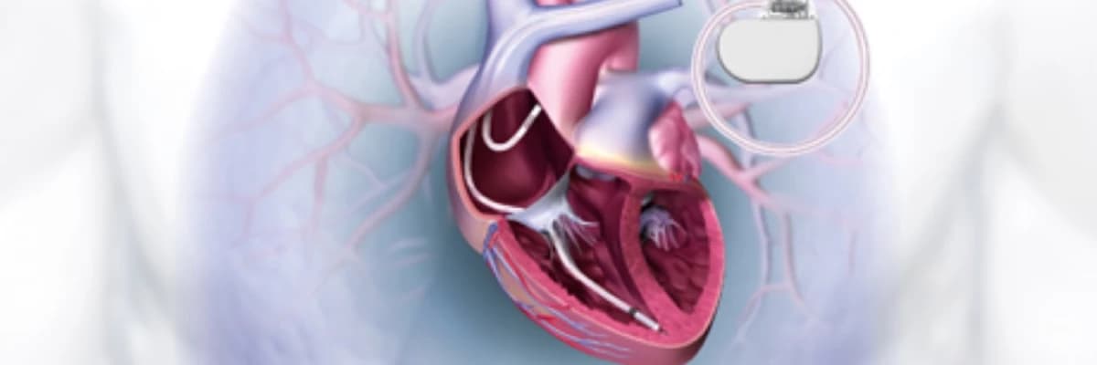 Defibrilasiya İmplantı: Ürək Ritmini Saxlamaq üçün Vacib Cihaz
