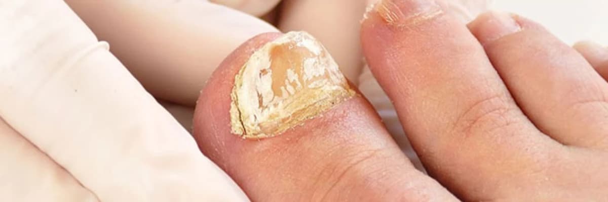 Mantar dırnaq infeksiyası: səbəbləri, müalicəsi, qarşısının alınması üsulları və tez-tez verilən suallar