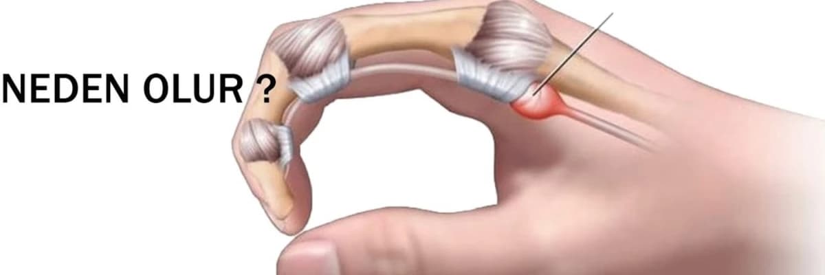 Tətik Barmaq nədir?