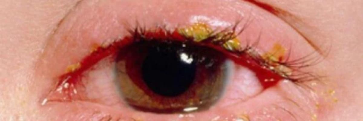 Adenovirus konyunktiviti