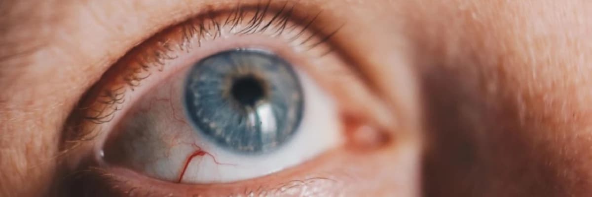 Keratit goz problemi nedir