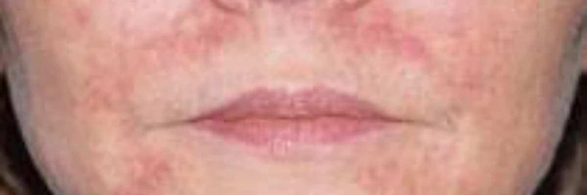 Perioral Piqmentasiya: Ağız Ətrafında Rənglənmənin Səbəbləri və Müalicə Yolları