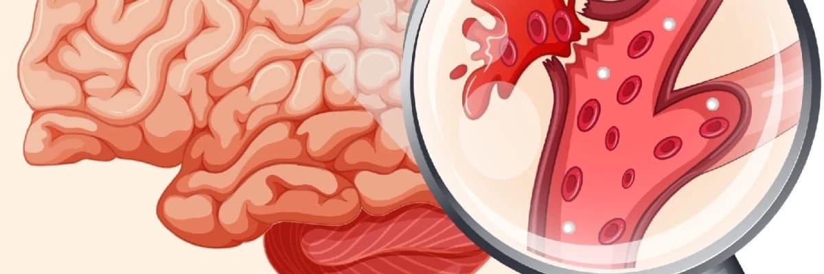 Serebral Qanaxma: Beyin Membranı və Toxumasında Baş Verən Qanaxma