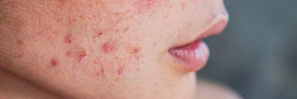 Sızanaq və sızanaq izləri