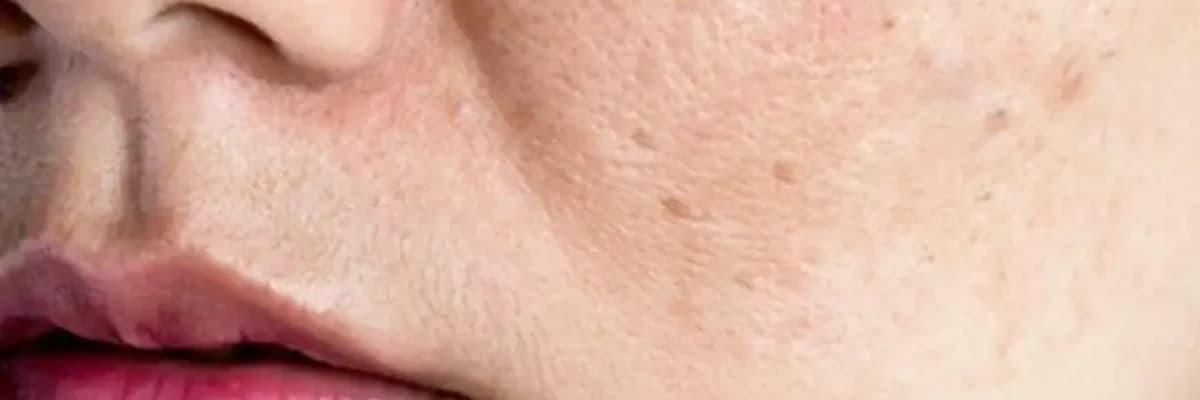 Dərinin virus xəstəlikləri