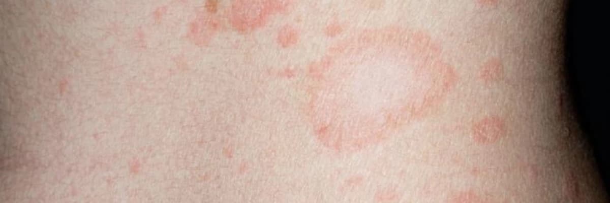 Medalyon xəstəliyi