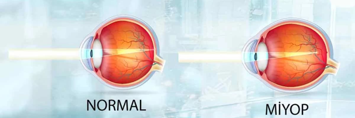 Miyopiya (yaxından görmə): Uzaq obyektlərin bulanıq müşahidə edildiyi bir göz problemi